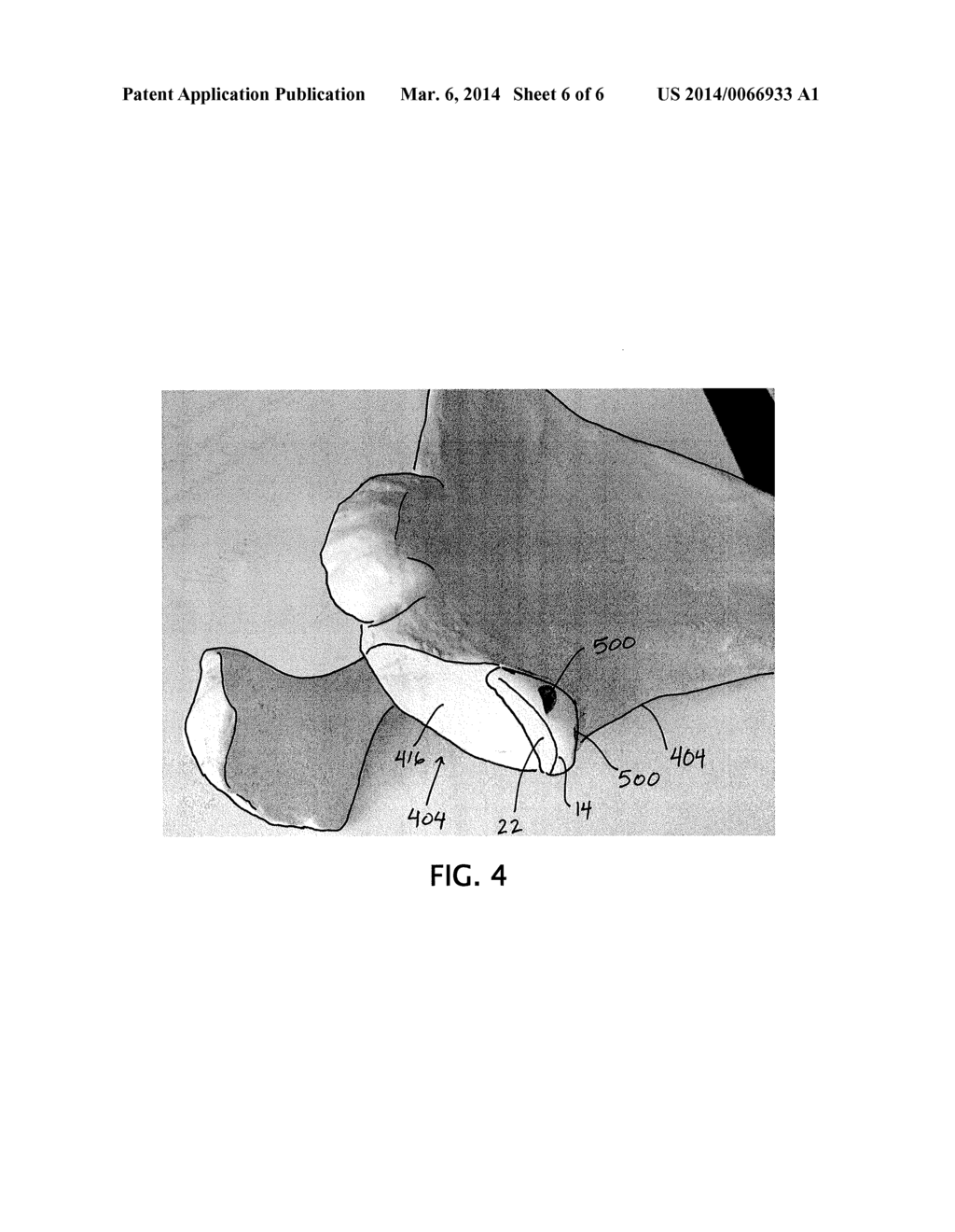 Devices, Apparatuses, Kits, and Methods for Repair of Articular Surface     and/or Articular Rim - diagram, schematic, and image 07