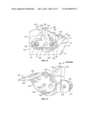 PATIENT-SPECIFIC PARTIAL KNEE GUIDES AND OTHER INSTRUMENTS diagram and image