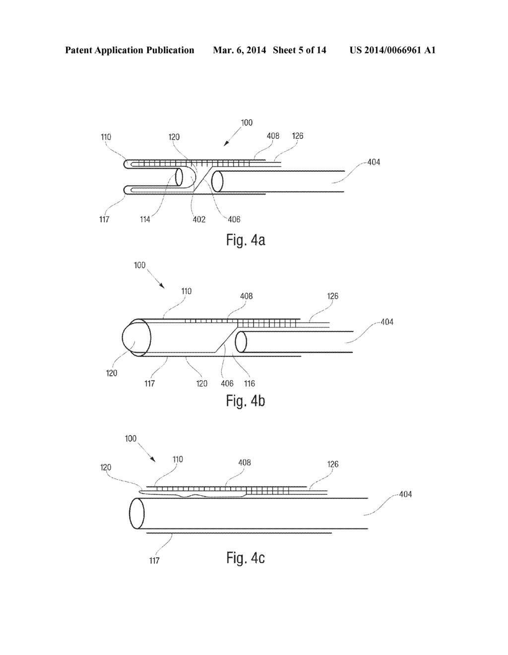 Catheter with Vessel Lining and Methods for Using Same - diagram, schematic, and image 06