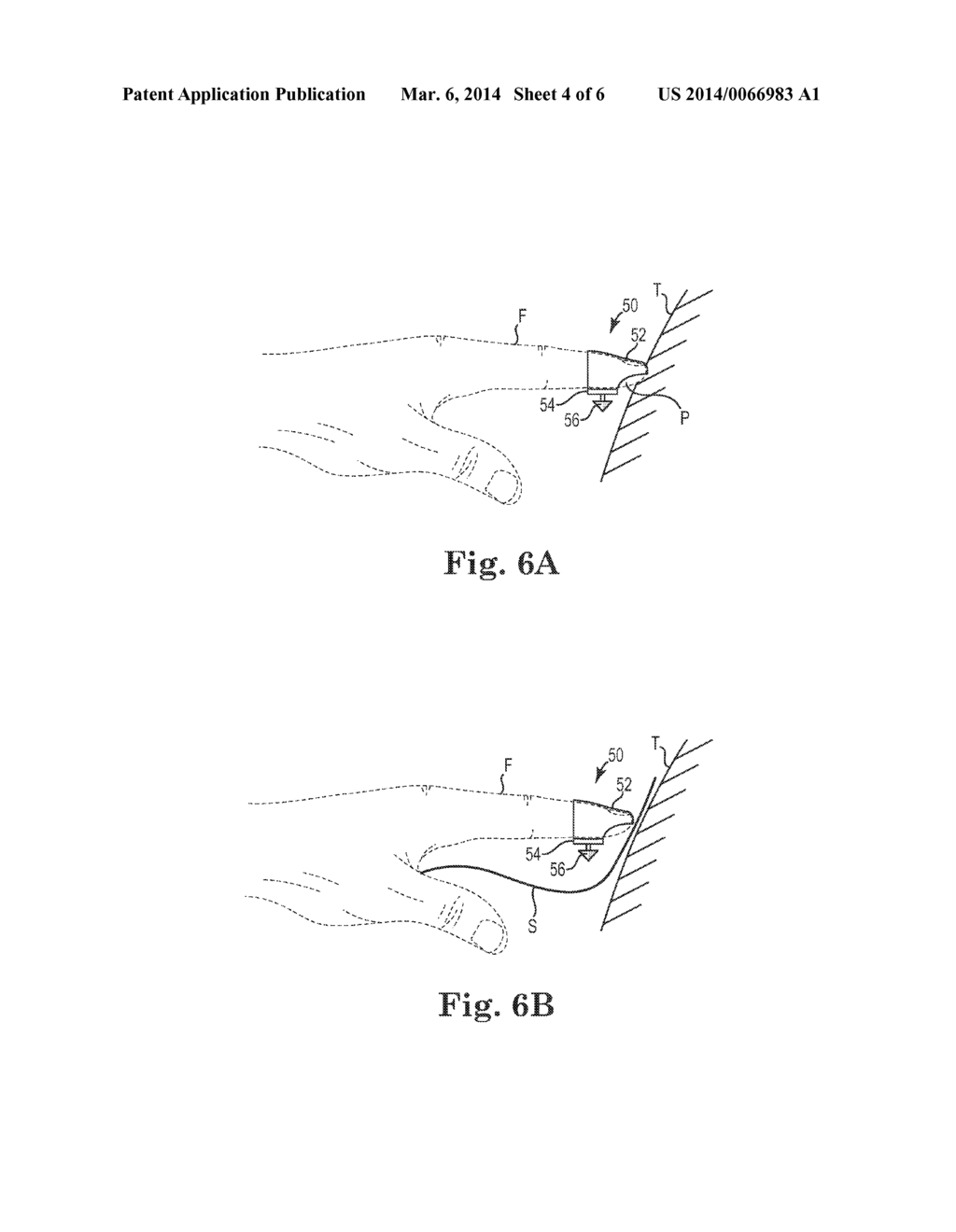 DIGITAL FIXATION METHOD OF IMPLANTING A SUPPORT IN A PATIENT - diagram, schematic, and image 05