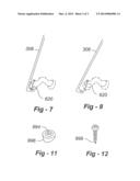 PERCUTANEOUS FACET FIXATION SYSTEM diagram and image