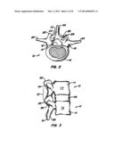 Adjacent Level Facet Arthroplasty Devices, Spine Stabilization Systems,     and Methods diagram and image