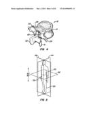 Adjacent Level Facet Arthroplasty Devices, Spine Stabilization Systems,     and Methods diagram and image