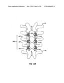 Adjacent Level Facet Arthroplasty Devices, Spine Stabilization Systems,     and Methods diagram and image