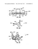 Adjacent Level Facet Arthroplasty Devices, Spine Stabilization Systems,     and Methods diagram and image