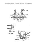 Adjacent Level Facet Arthroplasty Devices, Spine Stabilization Systems,     and Methods diagram and image