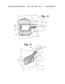 EXPANDABLE POROUS MESH BAG DEVICE AND METHODS OF USE FOR REDUCTION,     FILLING, FIXATION AND SUPPORTING OF BONE diagram and image