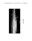 CONFORMABLE THERAPEUTIC SHIELD FOR VISION AND PAIN diagram and image