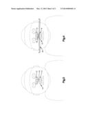 Infant Nasal Septum Protective Device diagram and image