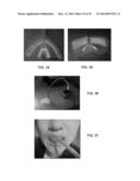 INTRA-ORAL LIGHT THERAPY APPARATUSES AND METHODS FOR THEIR USE diagram and image