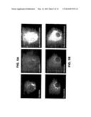 LAFORA S DISEASE GENE diagram and image