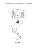 INCONTINENCE TREATMENT DEVICE diagram and image