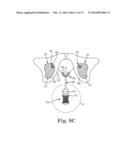 INCONTINENCE TREATMENT DEVICE diagram and image