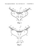 IMPLANTS, TOOLS, AND METHODS FOR TREATMENT OF PELVIC CONDITIONS diagram and image