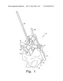 HUMERAL ROTATING BURR GUIDE diagram and image