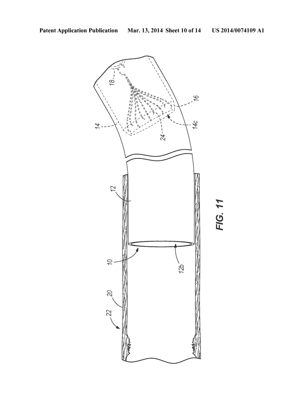 SYSTEM AND METHOD FOR REMOVING AN OBJECT FROM WITHIN A MAMMAL - diagram, schematic, and image 11