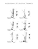 PRE-TIED SURGICAL KNOTS FOR USE WITH SUTURE PASSERS diagram and image