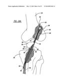 Flexible Planar Member For Tissue Fixation diagram and image