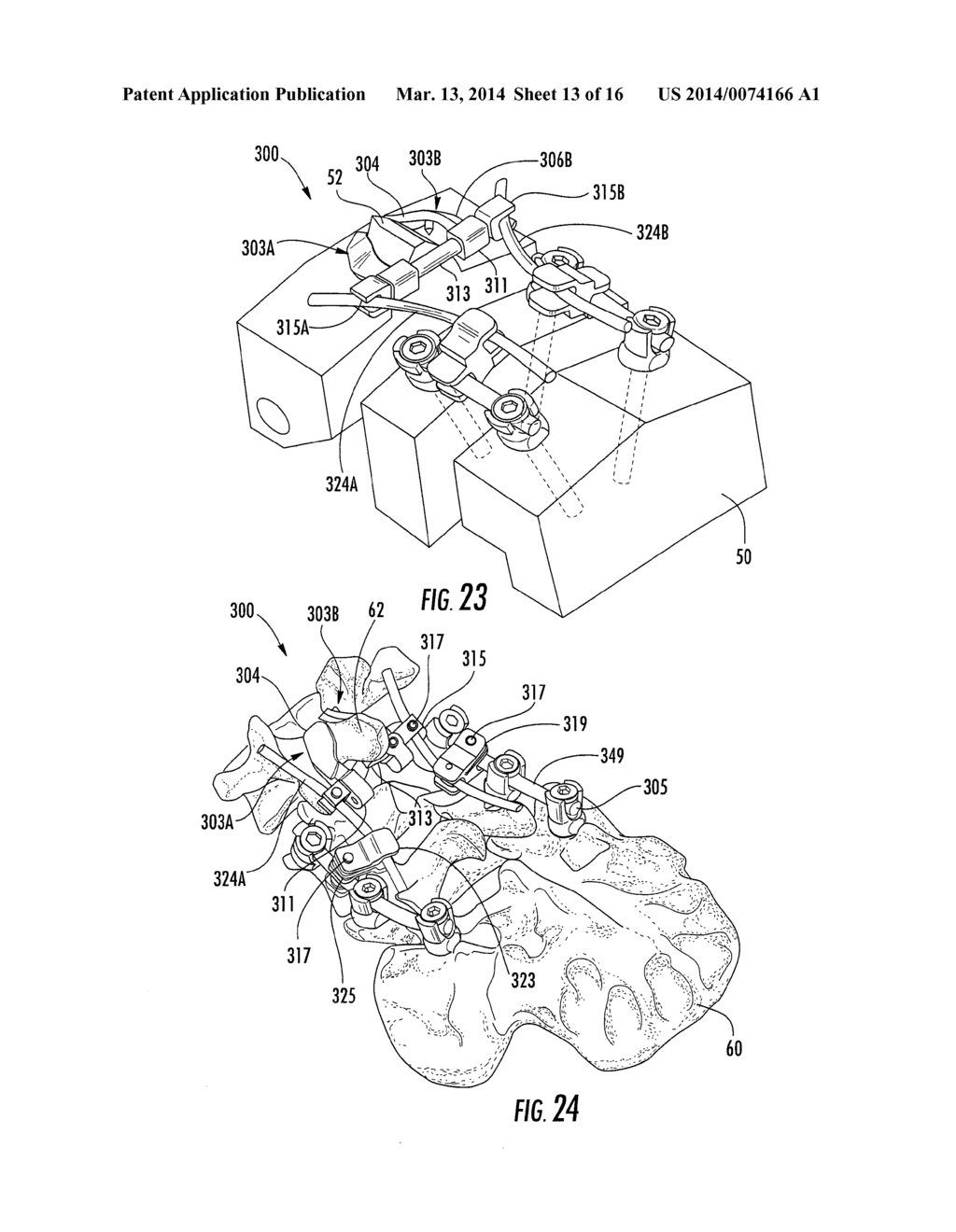 SPINOUS PROCESS FIXATION DEVICE AND SYSTEMS - diagram, schematic, and image 14