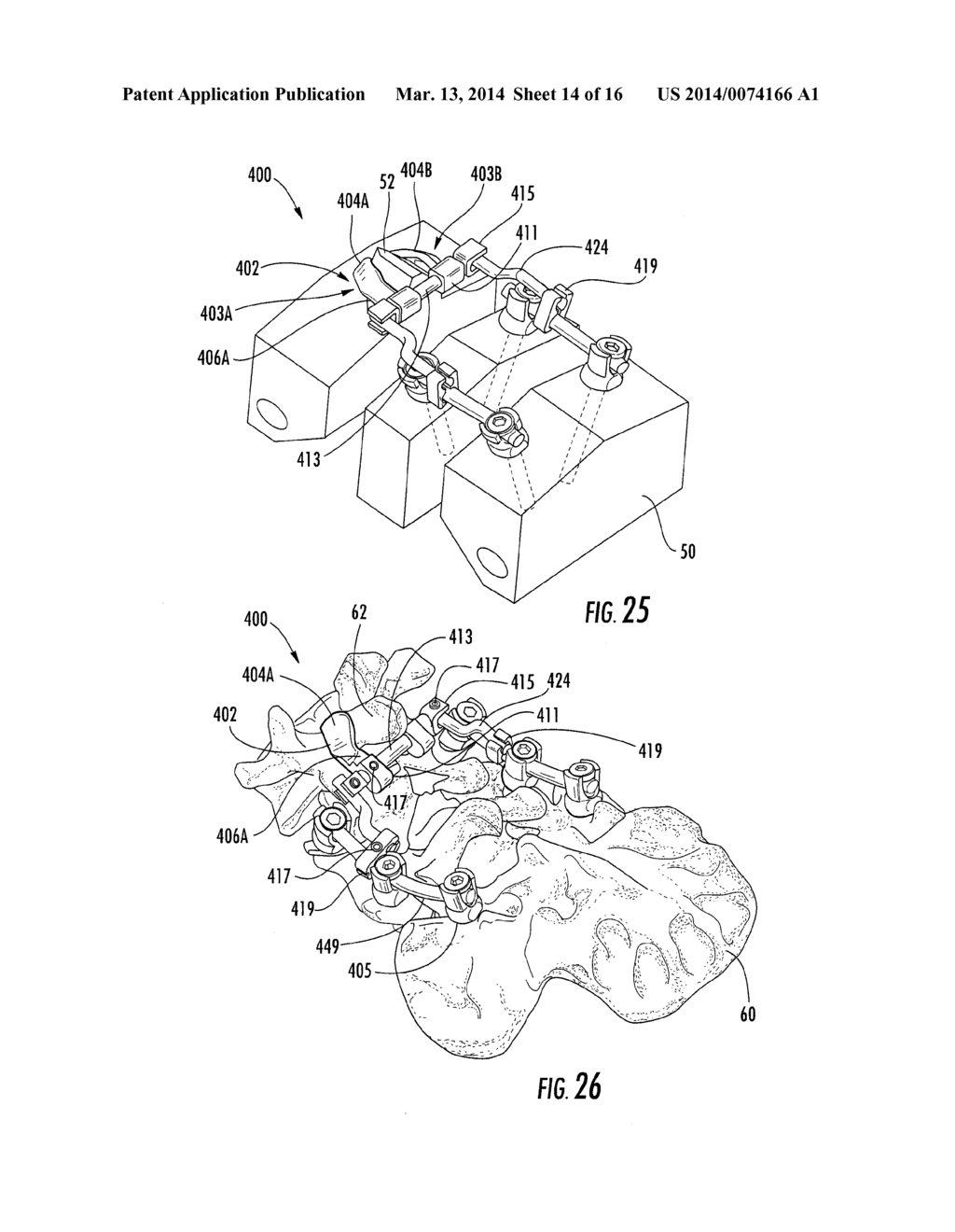 SPINOUS PROCESS FIXATION DEVICE AND SYSTEMS - diagram, schematic, and image 15