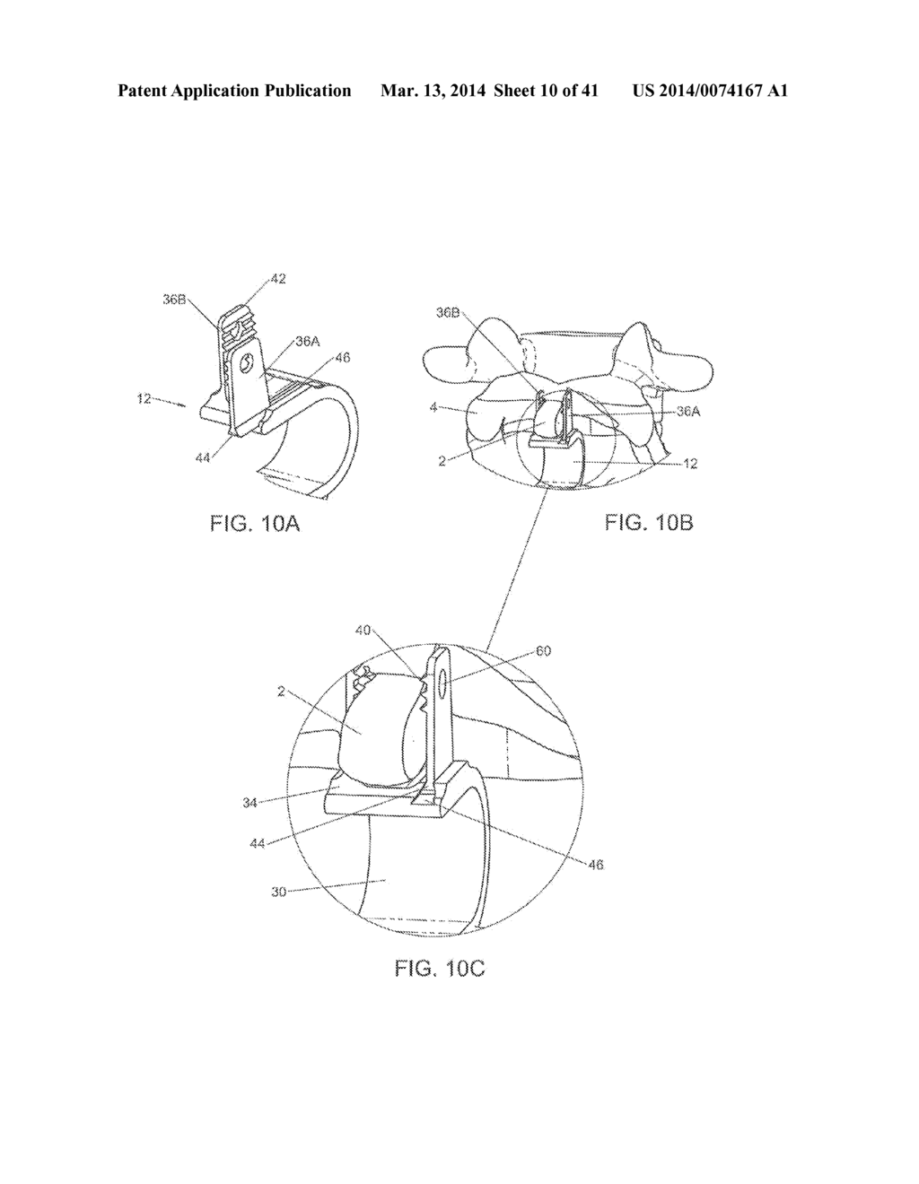 INTERSPINOUS VERTEBRAL AND LUMBOSACRAL STABILIZATION DEVICES AND METHODS     OF USE - diagram, schematic, and image 11