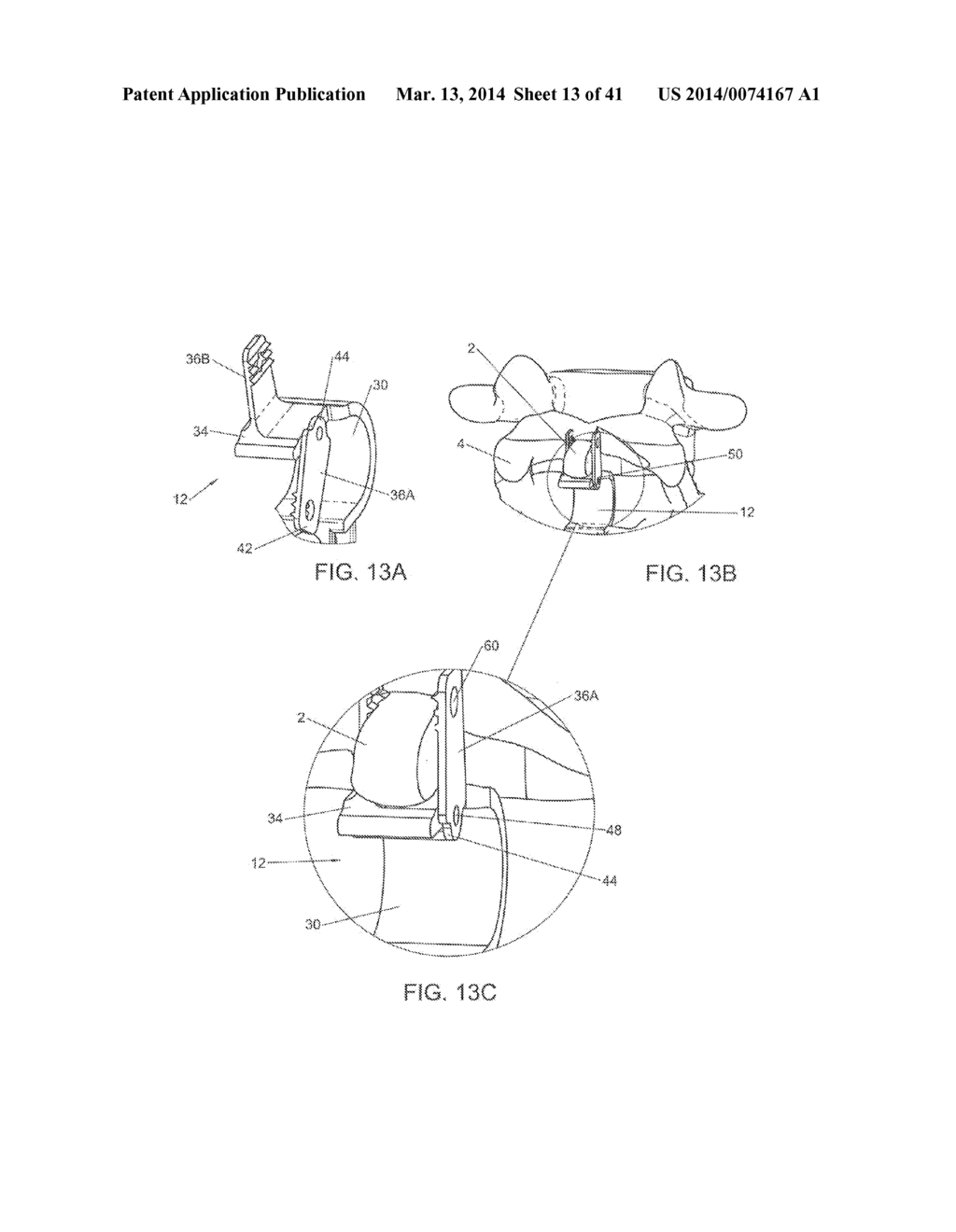 INTERSPINOUS VERTEBRAL AND LUMBOSACRAL STABILIZATION DEVICES AND METHODS     OF USE - diagram, schematic, and image 14