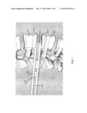 Delivery Device With Interior Dilation Element Channel diagram and image