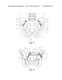 IMPLANT FOR PELVIC RING FRACTURES diagram and image