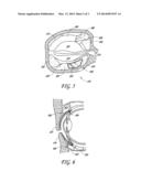 NON-SURGICAL ORBITAL FAT REDUCTION diagram and image