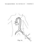 Transcatheter Prosthetic Heart Valve Delivery Device with Stability Tube     and Method diagram and image