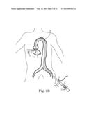 Transcatheter Prosthetic Heart Valve Delivery Device with Stability Tube     and Method diagram and image