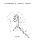 Transcatheter Prosthetic Heart Valve Delivery Device with Stability Tube     and Method diagram and image