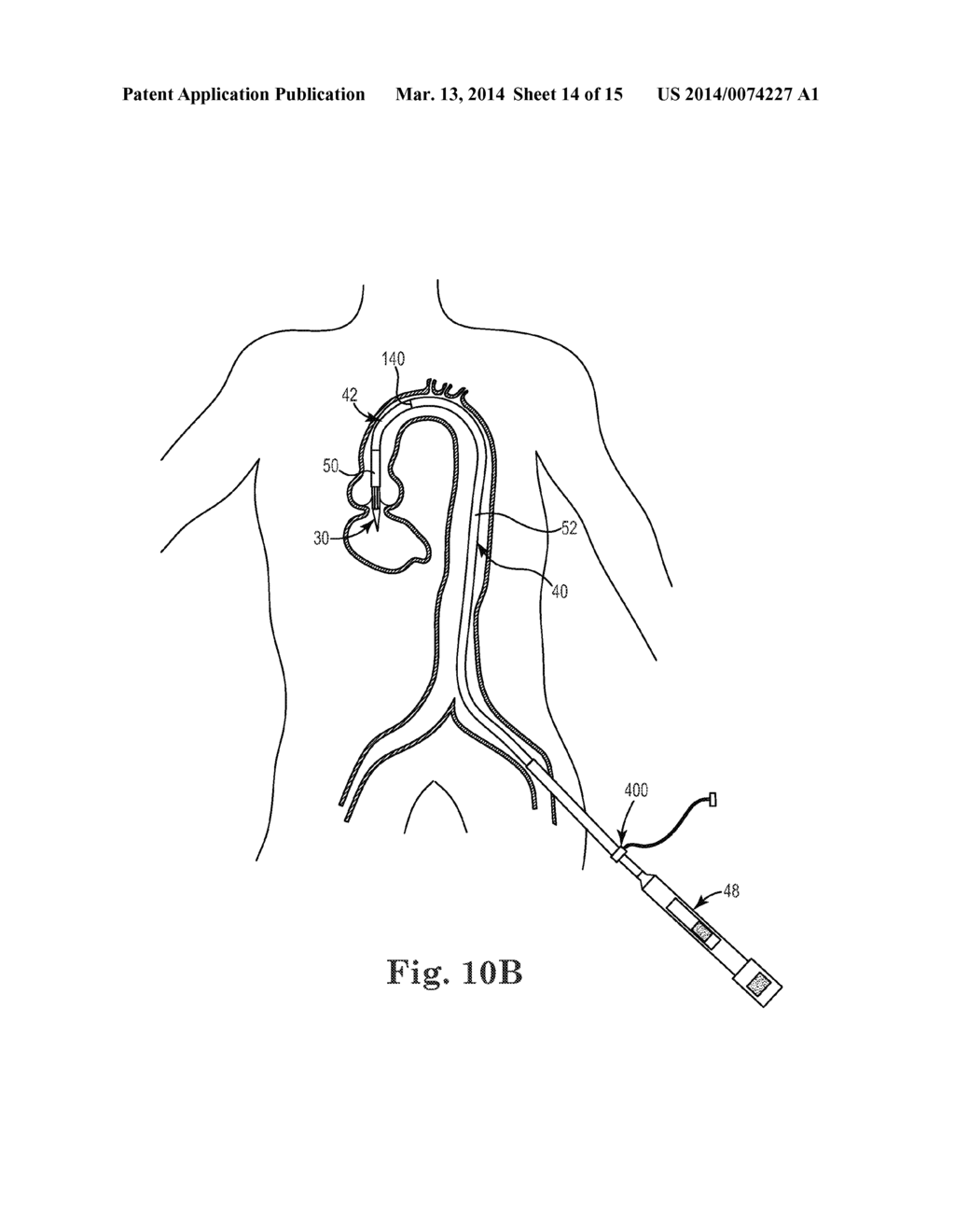 Transcatheter Prosthetic Heart Valve Delivery Device with Stability Tube     and Method - diagram, schematic, and image 15