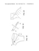 ADJUSTABLE SUTURE-BUTTON CONSTRUCTS FOR LIGAMENT RECONSTRUCTION diagram and image