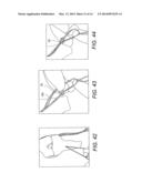 ADJUSTABLE SUTURE-BUTTON CONSTRUCTS FOR LIGAMENT RECONSTRUCTION diagram and image