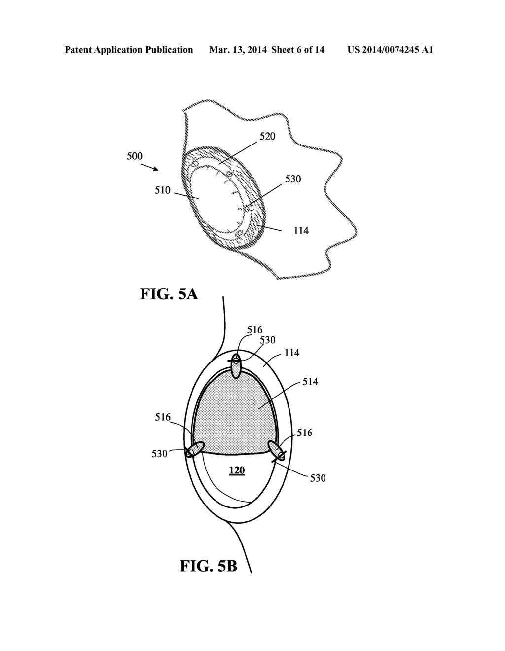 SHOULDER IMPLANT - diagram, schematic, and image 07