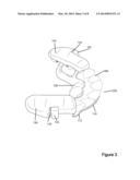 Dental Appliance for Treatment of Obstructive Sleep Apnea (OSA) and Sleep     Bruxism diagram and image