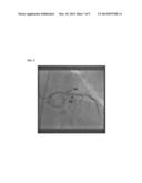 Method and System for Real Time Stent Enhancement on Live 2D Fluoroscopic     Scene diagram and image