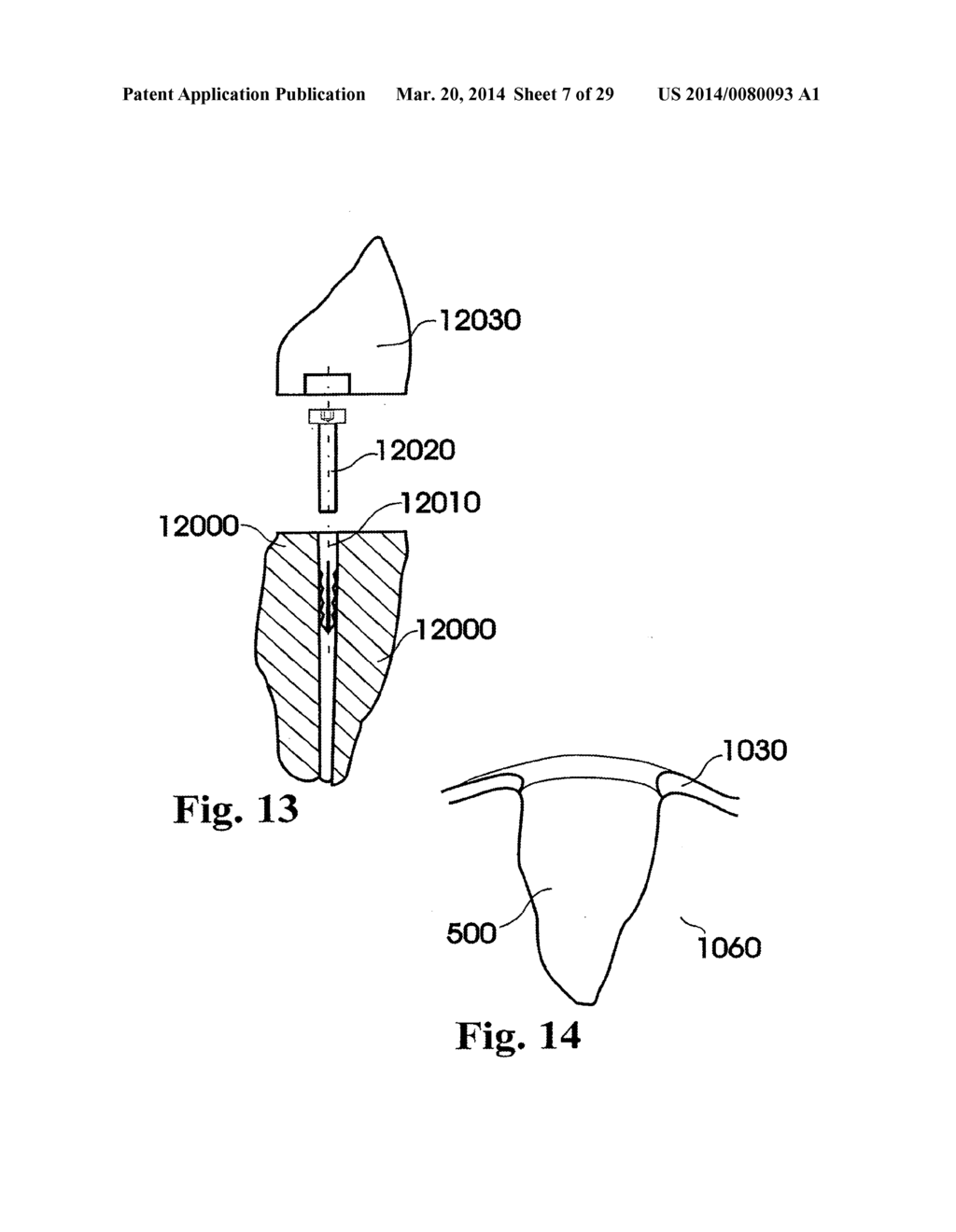 Customized Dental Prosthesis For Periodontal or Osseointegration, and     Related System and Methods - diagram, schematic, and image 08