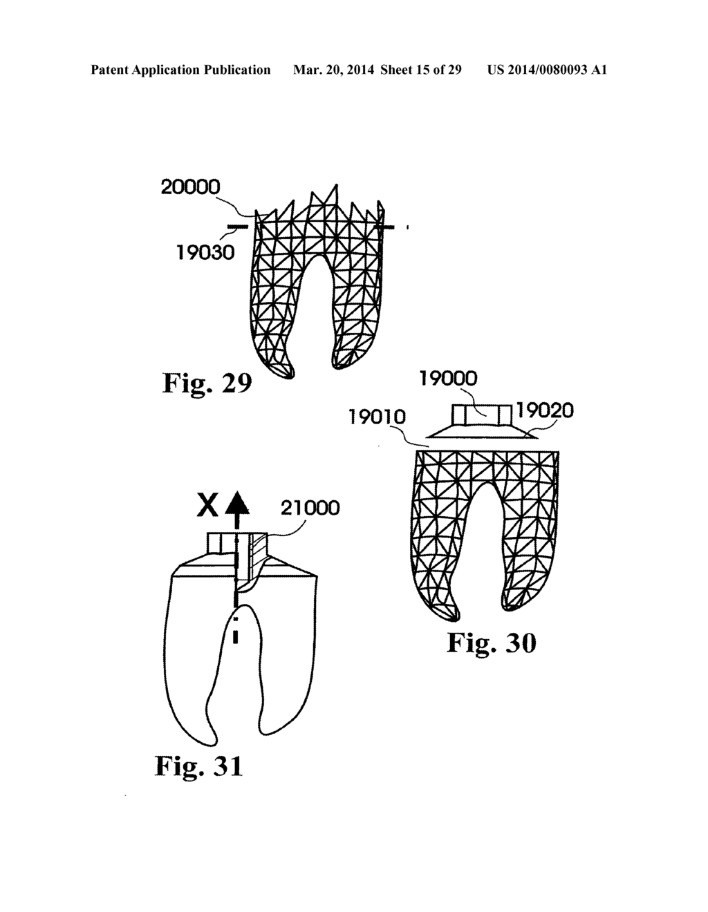 Customized Dental Prosthesis For Periodontal or Osseointegration, and     Related System and Methods - diagram, schematic, and image 16