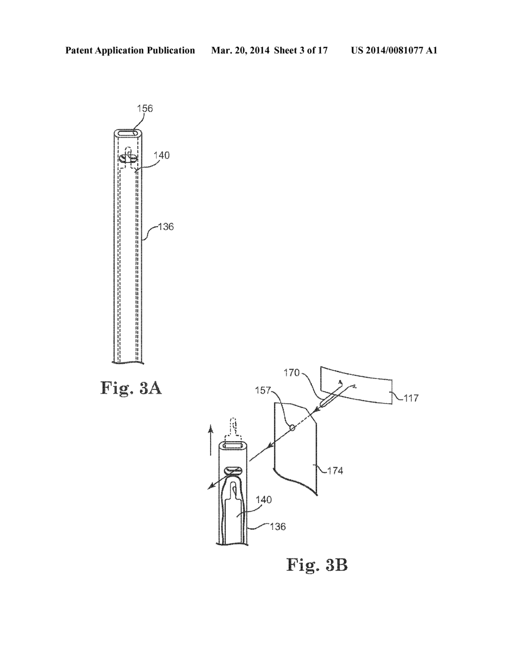 CARDIAC SUPPORT DEVICE DELIVERY TOOL WITH RELEASE MECHANISM - diagram, schematic, and image 04