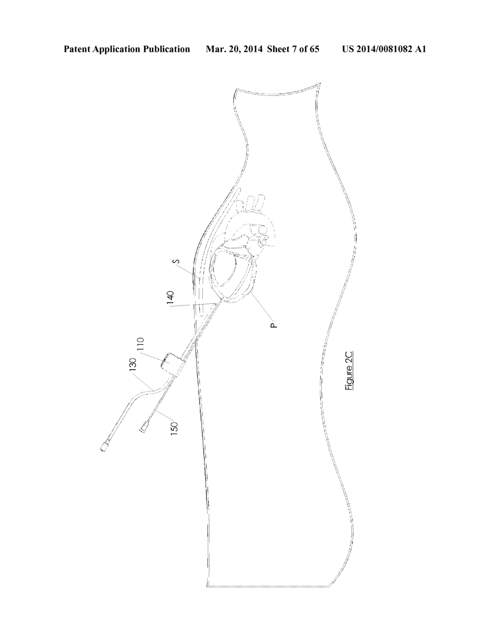 Methods and devices for visualization and access - diagram, schematic, and image 08