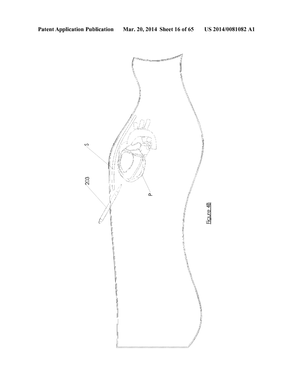 Methods and devices for visualization and access - diagram, schematic, and image 17