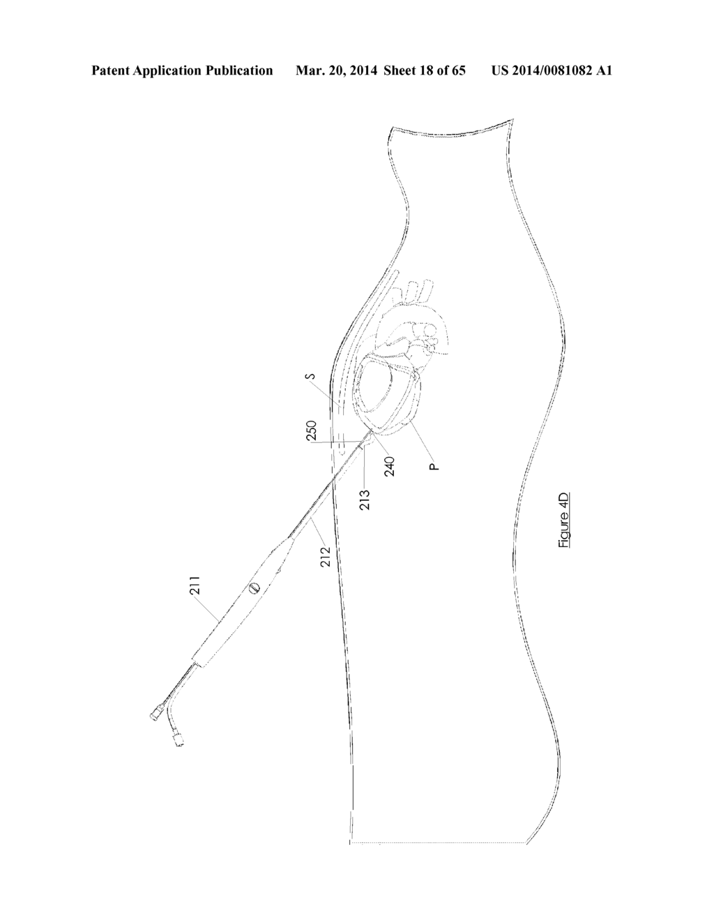 Methods and devices for visualization and access - diagram, schematic, and image 19