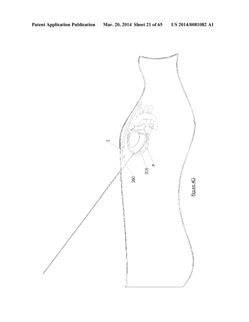 Methods and devices for visualization and access - diagram, schematic, and image 22