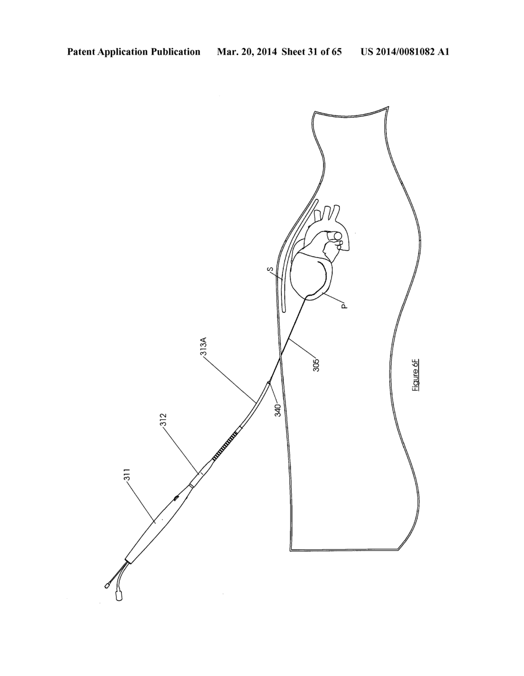 Methods and devices for visualization and access - diagram, schematic, and image 32