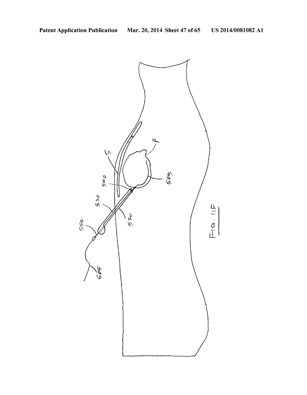 Methods and devices for visualization and access - diagram, schematic, and image 48