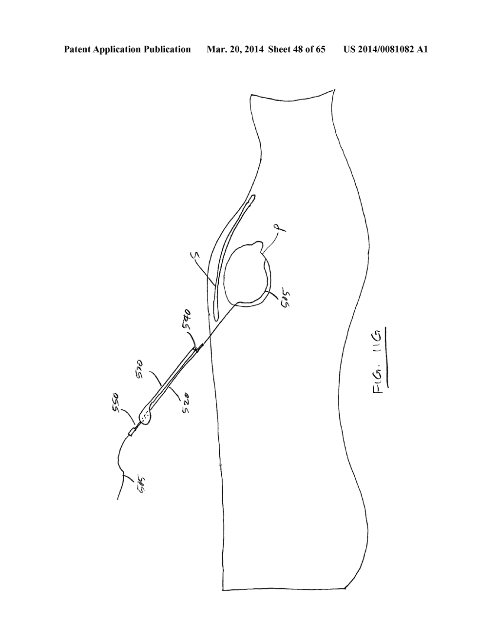 Methods and devices for visualization and access - diagram, schematic, and image 49