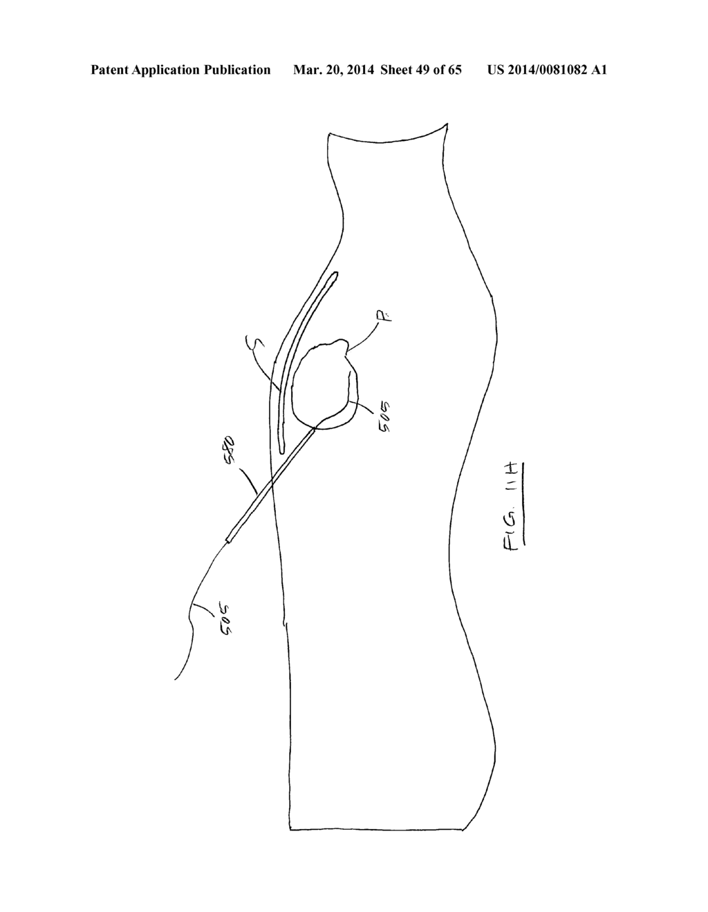 Methods and devices for visualization and access - diagram, schematic, and image 50