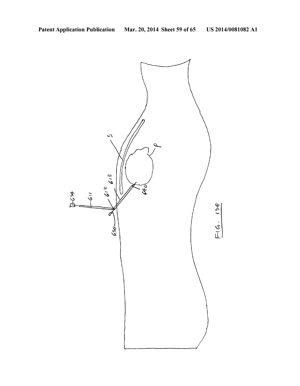 Methods and devices for visualization and access - diagram, schematic, and image 60